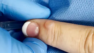 Wart or Cyst? Extracting a Bump on the Finger  | CONTOUR DERMATOLOGY