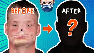 Miracle Face Transplant Saved His Life