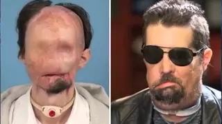 Man shows off first US full face transplant