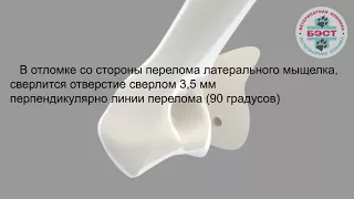 Фиксация неполного внутрисуставного перелома латерального мыщелка плечевой кости