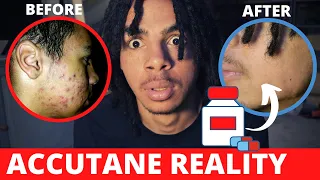 ACCUTANE BEFORE AND AFTER | IS ACCUTANE WORTH IT? HOW I CLEARED MY SEVERE ACNE FOR GOOD!!