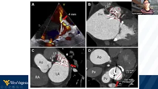 Advanced Imaging and Structural Heart Disease