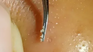 No squeezing whiteheads removal (Facial 32 right nose)