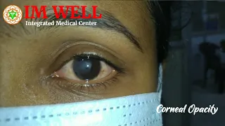 Corneal Opacity Eye Injury Cornea Injury