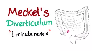 Meckel's Diverticulum (1-minute review)