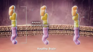 Current Treatments and Research for Alzheimer's Disease