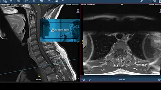 Multiple Sclerosis MRI: MS Lesions on Spine
