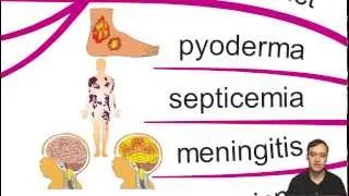 Bruton's X linked agammaglobulinemia