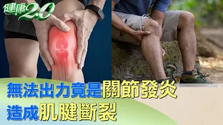 擰毛巾無法出力 竟是關節發炎造成肌腱斷裂 健康2.0