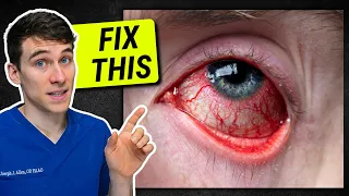 How to Get Rid of Red Eyes