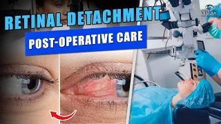 Talk About Post-Operative Care - Dr. Apoorv Grover - Vision Eye Center