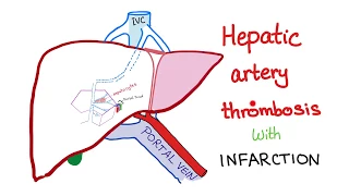 Hepatic Artery Thrombosis with infarction