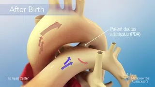 Patent Ductus Arteriosus (PDA) Occlusion Procedure