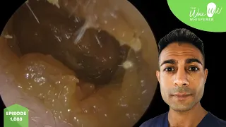 1,088 - 10 Years Worth of Ear Wax Removal