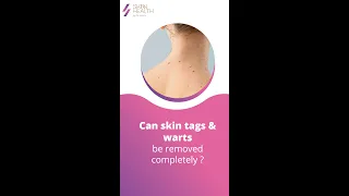 Can skin tags, moles, birthmarks & warts be removed completely ? | Dr Shruthi Vijayan | Skinn Health