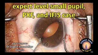 Small pupil, pseudo-exfoliation, floppy iris cataract surgery