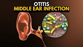 Middle Ear Infection (Otitis Media), Causes, SIgns and Symptoms, Diagnosis and Treatment.