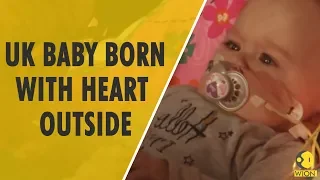 UK baby born with heart outside body allowed to visit home