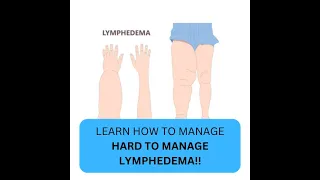 Learn how to manage your HARD TO MANAGE lymphedema!!