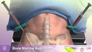Avascular Necrosis and Minimally Invasive Treatment Using Stem Cells - Mayo Clinic