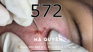 |572| Case acne 1 years old, very difficult, but I try finish 05/09/2023