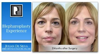 My personal experience of upper and lower blepharoplasty with Dr. Julian De Silva