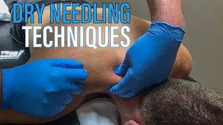 Dry Needling Therapy featuring Derek Brady