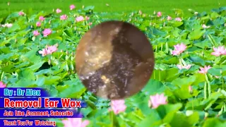 Remove biggest ear wax|removal ear wax  with Video HD and Relaxing Music#88