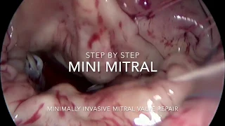 Step by Step Minimal Invasive Mitral Valve Repair