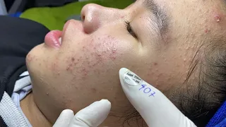 Acne treatment for Spa Linh Mun 2023 #111