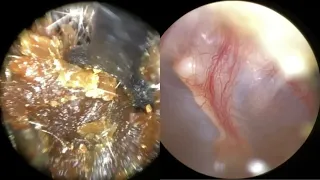 139 - Severe Ear Wax Blockage Removed using WAXscope®️& New Mechanical Instruments