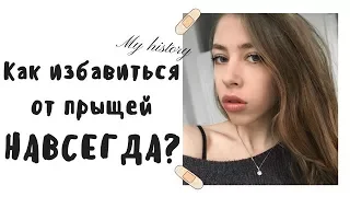 КАК Я ИЗБАВИЛАСЬ ОТ ПРЫЩЕЙ? ♡ МОЯ ИСТОРИЯ | УХОД ЗА КОЖЕЙ