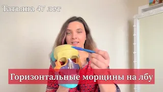 Морщины на лбу