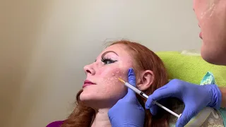 Acne Scar Treatment with Bellafill dermal filler in Seattle at Well Medical Arts