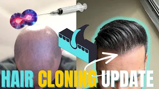 Hair Clone UPDATE - Hair Transplant Network Podcast Episode 19