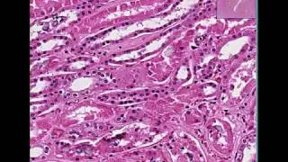 Histopathology Kidney --Acute tubular necrosis from ethylene