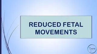 RCOG GUIDELINE REDUCED FETAL MOVEMENTS