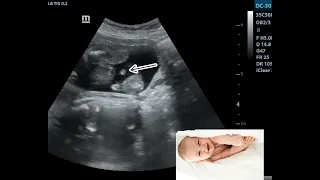 Ultrasound Showing Baby Boy in breech Presentation