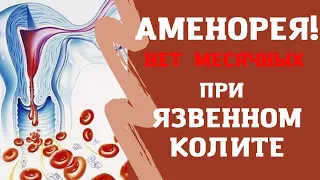 Аменорея. Пропали месячные при язвенном колите. Что делать?