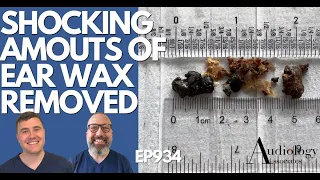 SHOCKING AMOUNTS OF EAR WAX REMOVED - EP934