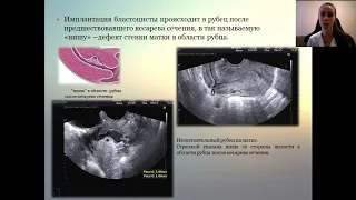 ЗНАЧЕНИЕ УЛЬТРАЗВУКОВ. МЕТОДА ИССЛЕДОВАНИЯ В ДИАГНОСТИКЕ ЭКТОПИЧЕСКОЙ БЕРЕМЕННОСТИ В РУБЦЕ НА МАТКЕ