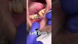 Dental Cleaning! Removal of dental Calculus