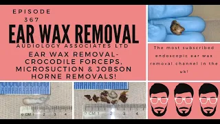 EAR WAX REMOVAL - CROCODILE FORCEPS, MICROSUCTION AND JOBSON HORNE REMOVALS - EP367