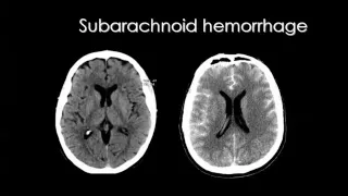 Cerebro vascular diseases Dr Mamdouh Mahfouz