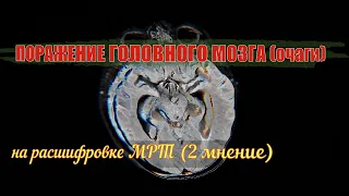 ПОРАЖЕНИЕ головного мозга неуточненное (МЕТАСТАЗЫ головного мозга) на расшифровке МРТ