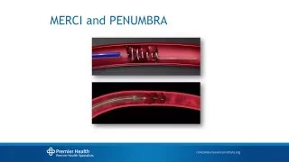 Acute Ischemic Stroke Treatment 2015 by Esteban Cheng-Ching, MD