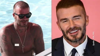 Haartransplantation von David Beckham?