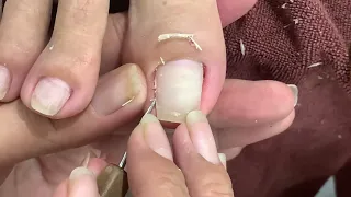 deep leg skin cutting technique#269