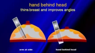 Optimizing Breast Sonography