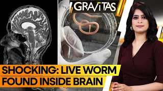 Gravitas: Brain Worm Nightmare: Doctors Pull Live Parasite from Patient's Brain